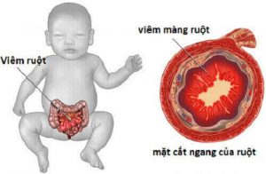 bệnh thường gặp khi uống nước ô nhiễm