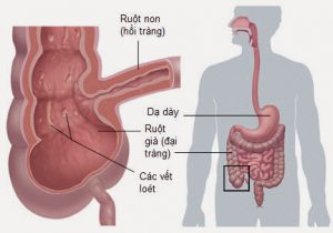 Bệnh viêm ruột - tác hại nghiêm trọng từ việc uống nước bẩn