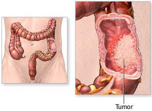 Bệnh viêm ruột - tác hại nghiêm trọng từ việc uống nước bẩn